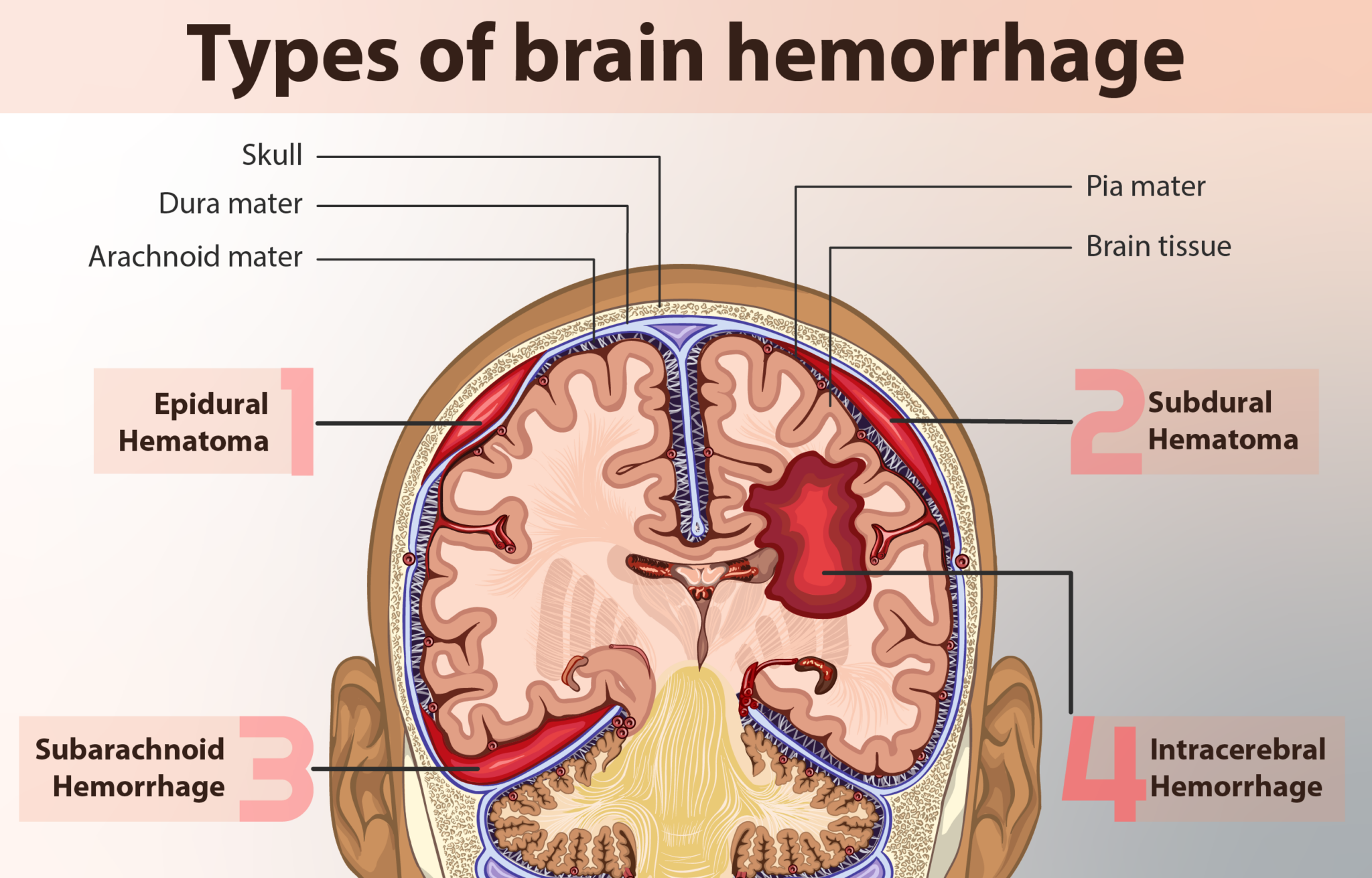 brain-hemorrhage-treatment-dr-samir-parekh